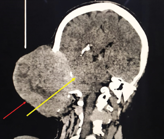 Coronal view showing well-defined lytic lesion (red arrow) in the occipital bone, right side involving soft tissue of the overlying scalp and compressing right cerebellar hemisphere and right temporo-occipital lobes (yellow arrow).
